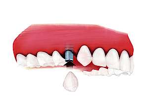 Zahnlücke mit Implantatpfosten