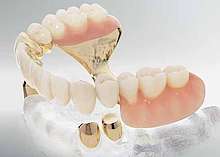 Prothesen als fester Zahnersatz